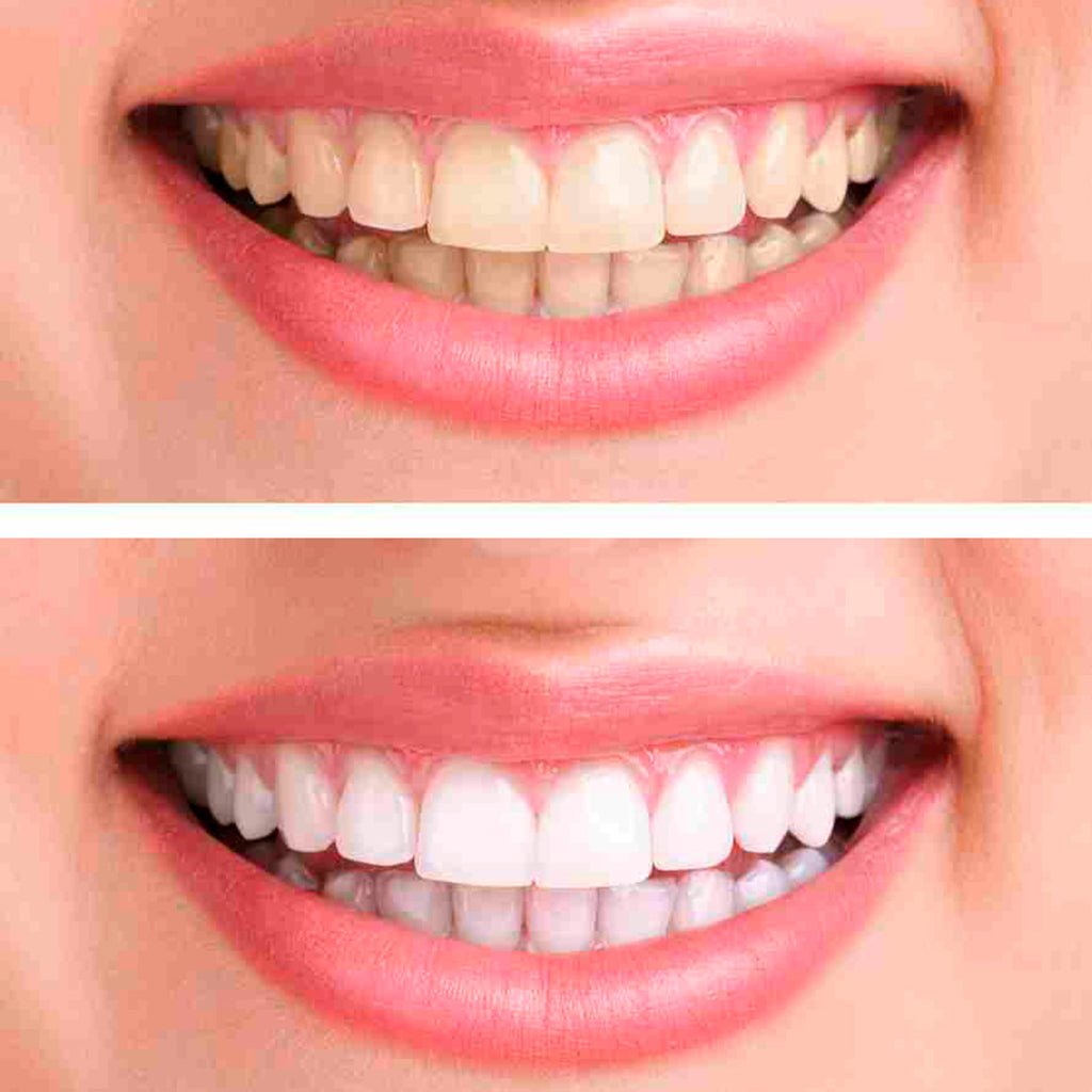 Tiras blanqueadoras púrpura para una sonrisa más blanca en 30 min