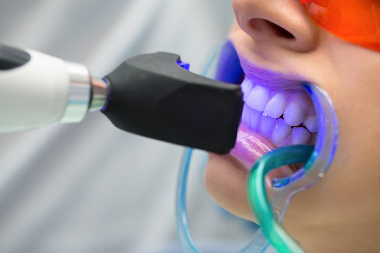 Blanqueamiento dental en clínica con lámpara de luz azul y separador bucal